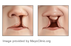 cleft palate